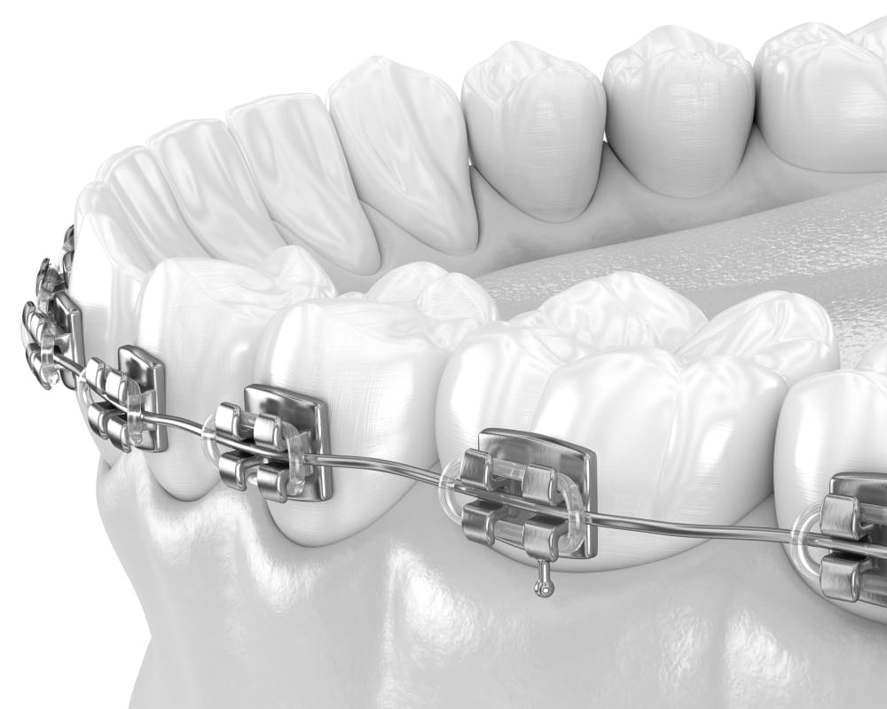 Traditional Metal Braces, Manteca Orthodontist