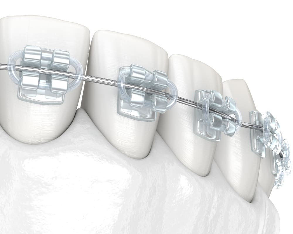 Translucent Braces, Manteca Orthodontist