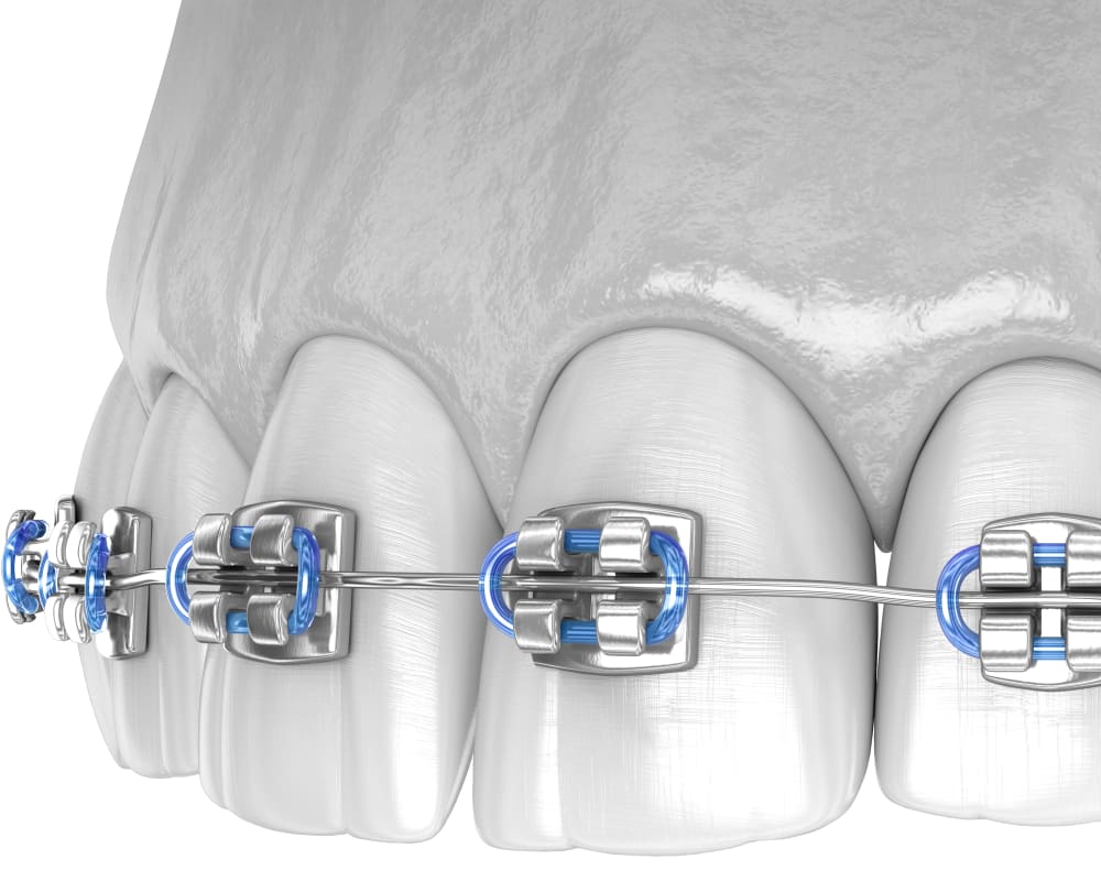 Colored Braces, Manteca Orthodontist
