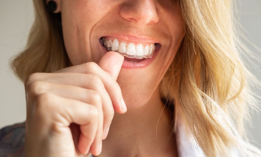 Low-Profile Esthetics of Clear Aligners at Duong Orthodontics